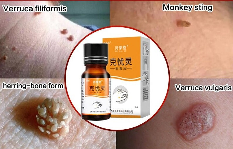 molluscum contagiosum treatment Helps Reduce Warts, Lesions & Infections Caused by Viral Infections