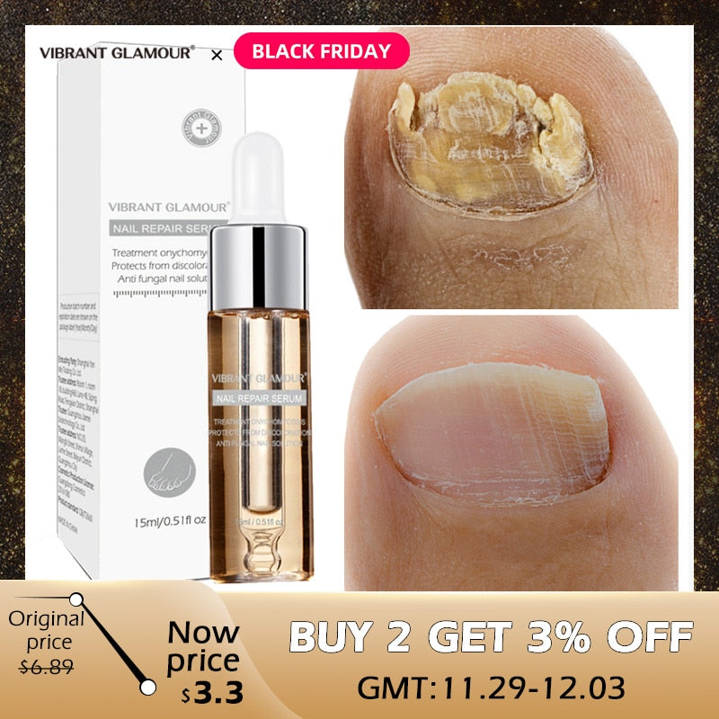Fingernail fungus - Fungal Nail Treatment - Toenail Fungus