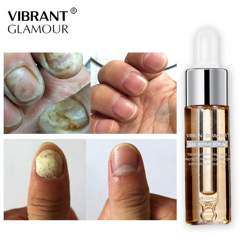 Fingernail fungus - Fungal Nail Treatment - Toenail Fungus