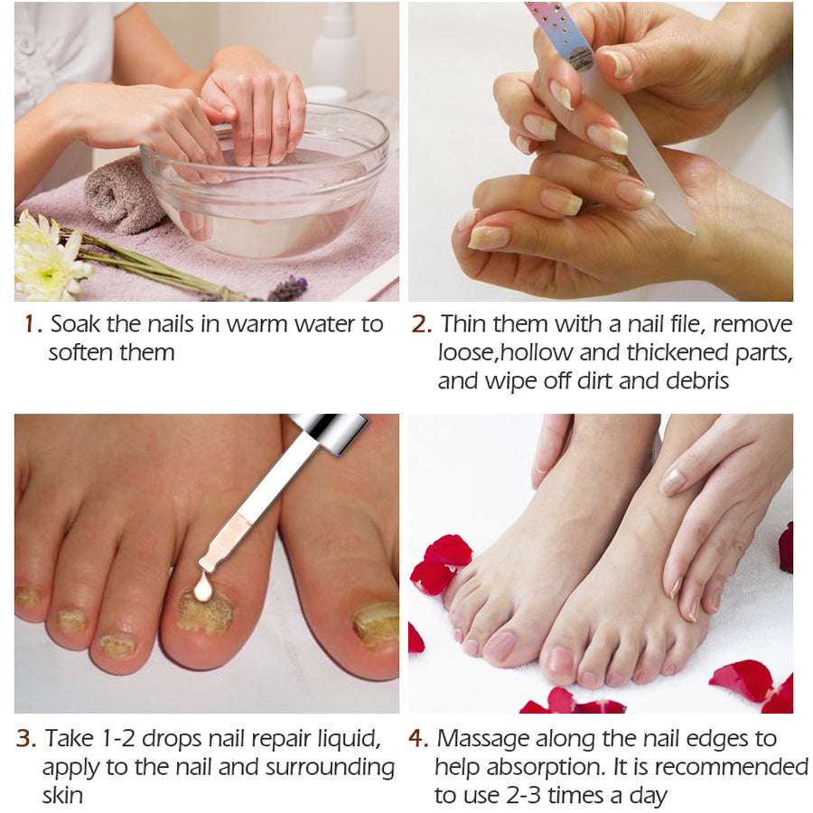 Fingernail fungus - Fungal Nail Treatment - Toenail Fungus