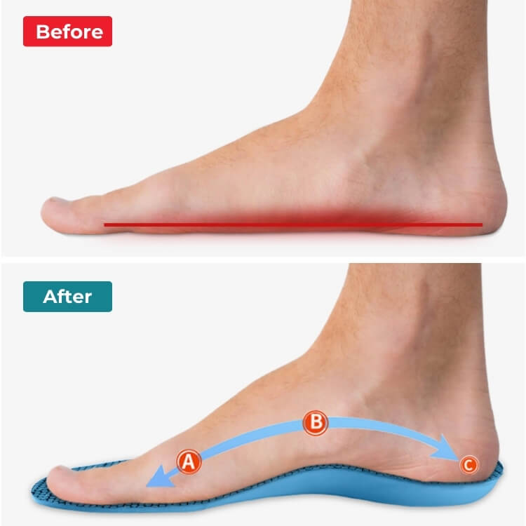 ComfySole Orthotic Insoles | Insoles for Bunions & Plantar Fasciitis