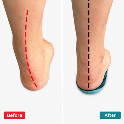 ComfySole Orthotic Insoles | Insoles for Bunions & Plantar Fasciitis