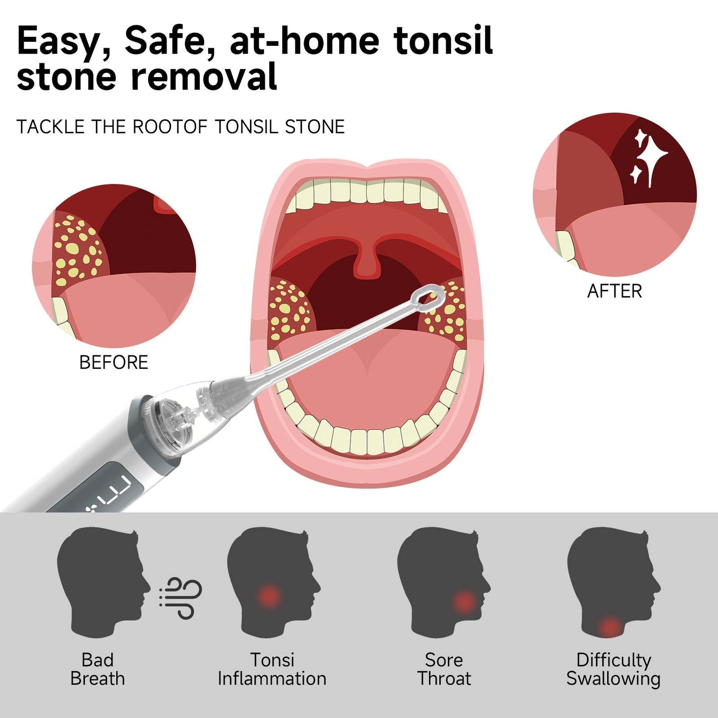 Tonsil Stone Removal Kit with Irrigation Syringe – Effective Tool for Tonsilith Extraction