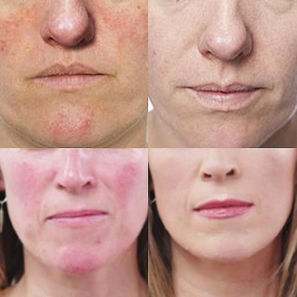 K - Rosacea formula best rosacea treatment