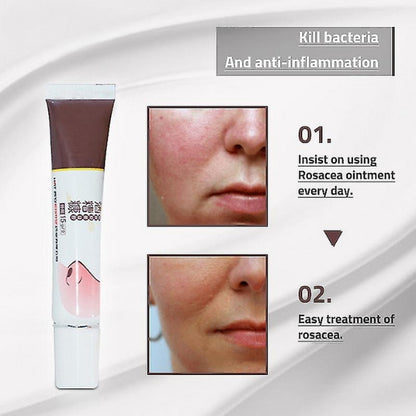 K - Rosacea formula best rosacea treatment