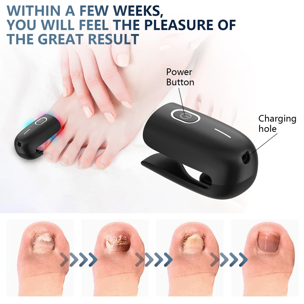 Laser Heal Toenail Fungus Removal Laser