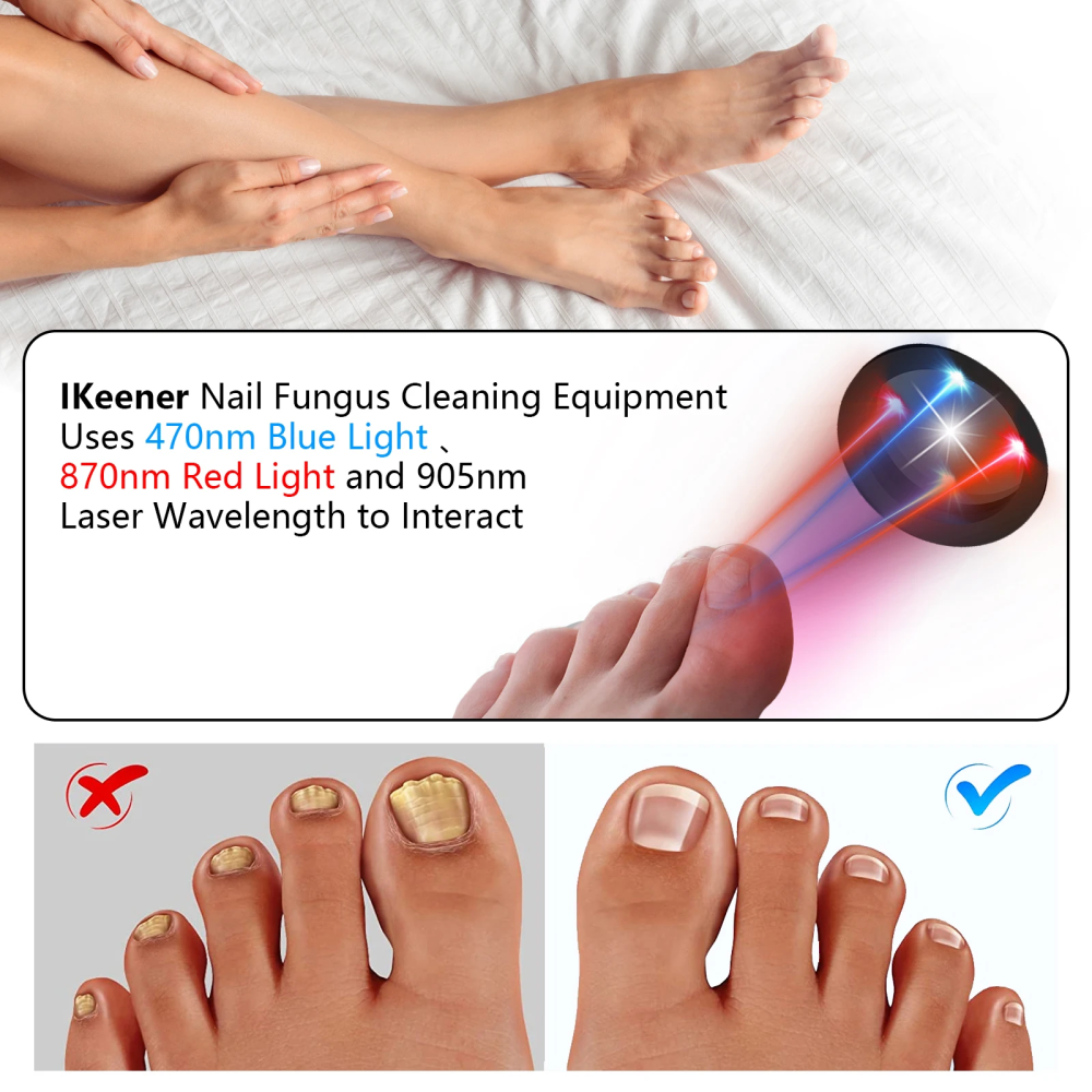 Laser Heal Toenail Fungus Removal Laser