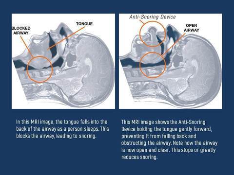 Apnea Tongue Stabilizing Device - Balma Home