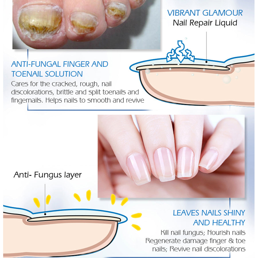 Fingernail fungus - Fungal Nail Treatment - Toenail Fungus